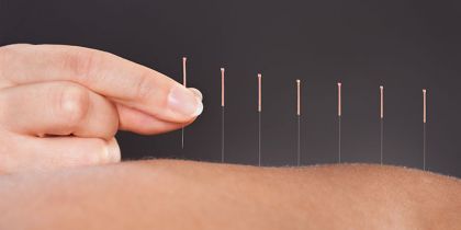 Conheça os benefícios da acupuntura